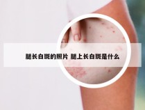 腿长白斑的照片 腿上长白斑是什么