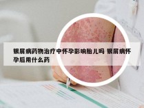 银屑病药物治疗中怀孕影响胎儿吗 银屑病怀孕后用什么药