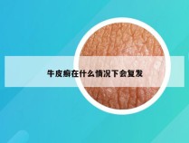 牛皮癣在什么情况下会复发