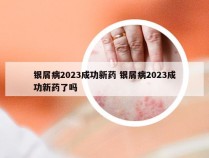 银屑病2023成功新药 银屑病2023成功新药了吗