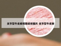 关节型牛皮癣初期症状图片 关节型牛皮鲜