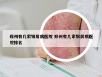 郑州有几家银屑病医院 郑州有几家银屑病医院排名