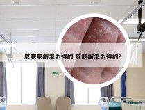 皮肤病癣怎么得的 皮肤癣怎么得的?