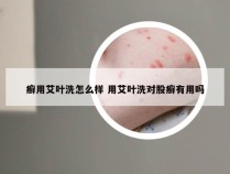 癣用艾叶洗怎么样 用艾叶洗对股癣有用吗