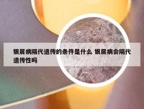 银屑病隔代遗传的条件是什么 银屑病会隔代遗传性吗