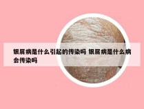 银屑病是什么引起的传染吗 银屑病是什么病会传染吗