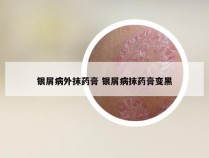 银屑病外抹药膏 银屑病抹药膏变黑