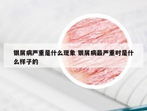 银屑病严重是什么现象 银屑病最严重时是什么样子的