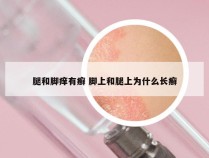 腿和脚痒有癣 脚上和腿上为什么长癣