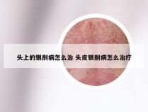 头上的银削病怎么治 头皮银削病怎么治疗