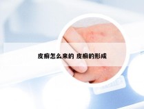 皮癣怎么来的 皮癣的形成