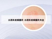 小孩长皮癣图片 小孩长皮癣图片大全