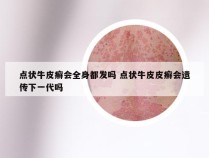 点状牛皮癣会全身都发吗 点状牛皮皮癣会遗传下一代吗