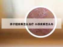 孩子妞皮癣怎么治疗 小孩皮癣怎么办