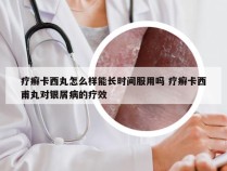 疗癣卡西丸怎么样能长时间服用吗 疗癣卡西甫丸对银屑病的疗效