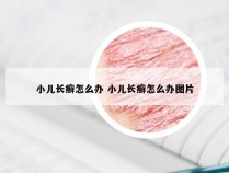 小儿长癣怎么办 小儿长癣怎么办图片