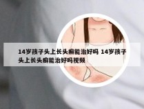 14岁孩子头上长头癣能治好吗 14岁孩子头上长头癣能治好吗视频