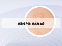 癣治疗办法 癣怎样治疗