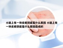 小腿上有一块皮癣到底是什么原因 小腿上有一块皮癣到底是什么原因造成的