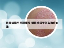 银屑病指甲初期图片 银屑病指甲怎么治疗方法