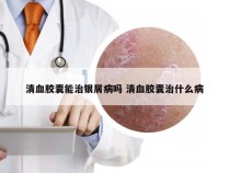 清血胶囊能治银屑病吗 清血胶囊治什么病