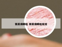 银屑病眼睑 银屑病眼睑蜕皮