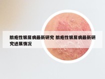 脓疱性银屑病最新研究 脓疱性银屑病最新研究进展情况