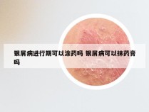 银屑病进行期可以涂药吗 银屑病可以抹药膏吗