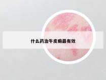 什么药治牛皮癣最有效