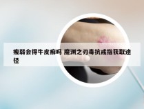 瘦弱会得牛皮癣吗 魔渊之刃毒抗戒指获取途径