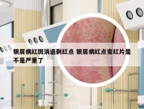 银屑病红斑消退剩红点 银屑病红点变红片是不是严重了