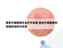 银杏叶提取物片治疗牛皮癣 银杏叶提取物对皮肤的功效与作用