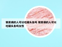 银屑病的人可以吃罐头鱼吗 银屑病的人可以吃罐头鱼吗女性