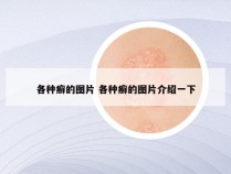 各种癣的图片 各种癣的图片介绍一下