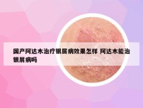 国产阿达木治疗银屑病效果怎样 阿达木能治银屑病吗