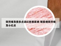 突然爆发很多点滴红色银屑病 银屑病突然爆发小红点