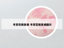 寻常性银屑病 寻常型银屑病图片