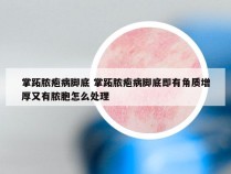 掌跖脓疱病脚底 掌跖脓疱病脚底即有角质增厚又有脓胞怎么处理