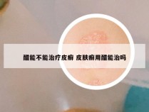 醋能不能治疗皮癣 皮肤癣用醋能治吗