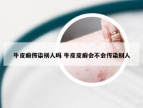 牛皮癣传染别人吗 牛皮皮癣会不会传染别人