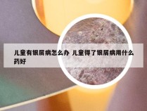 儿童有银屑病怎么办 儿童得了银屑病用什么药好