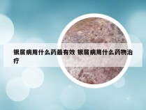 银屑病用什么药最有效 银屑病用什么药物治疗