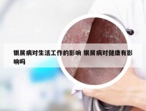 银屑病对生活工作的影响 银屑病对健康有影响吗