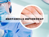 顽固的牛皮癣怎么治 顽固牛皮鲜怎样治疗