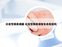 红皮性银屑病图 红皮型银屑病有生命危险吗