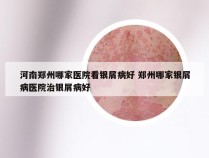 河南郑州哪家医院看银屑病好 郑州哪家银屑病医院治银屑病好