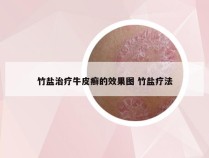 竹盐治疗牛皮癣的效果图 竹盐疗法