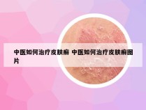 中医如何治疗皮肤癣 中医如何治疗皮肤癣图片