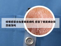 咳嗽感冒会加重银屑病吗 感冒了银屑病会突然爆发吗