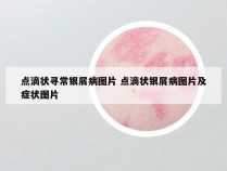 点滴状寻常银屑病图片 点滴状银屑病图片及症状图片